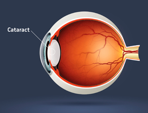 Prevent cataracts naturally.