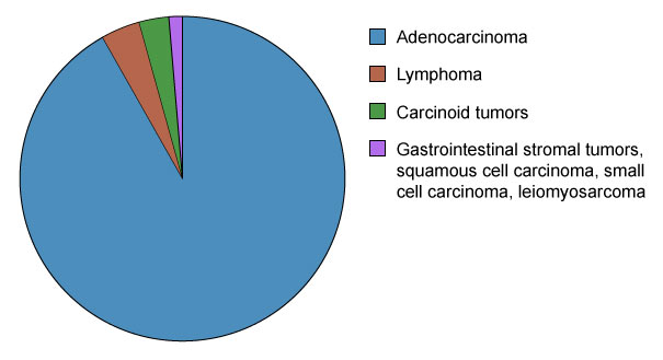 Stomach Cancer Types - by Prevalence