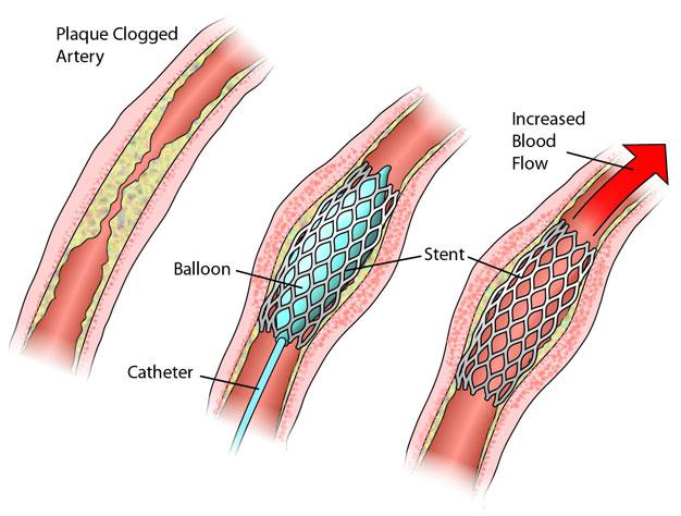 Figure VII.12: Angioplasty with Stent