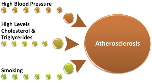Atherosclerosis figure