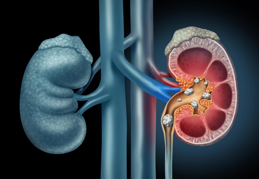 Turmeric Safety - Kidney Stones Can turmeric cause kidney stones?