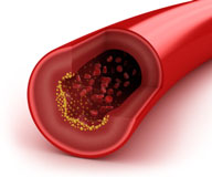 Cholesterol clogged artery