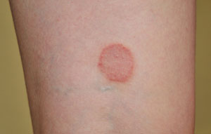 ringworm infection on the skin