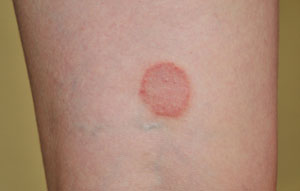 ringworm infection on the skin ringworm infection on the skin