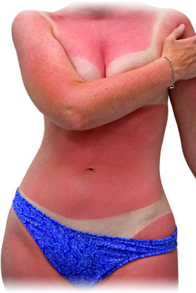 Sunburnt Woman at risk for Skin Cancer