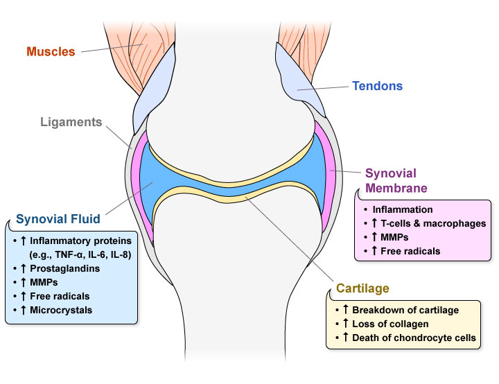 Figure V.3: Arthritis in the Knee