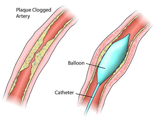 Figure VII.11: Angioplasty