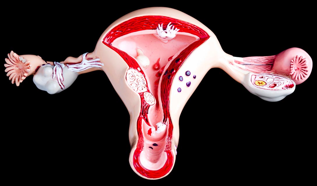 Turmeric compounds may help shrink uterine fibroids.